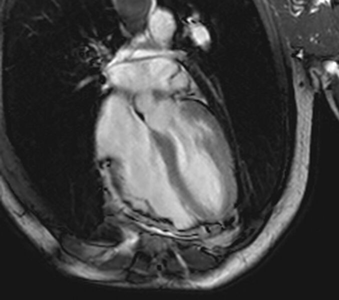 File:Arrhythmogenic right ventricular cardiomyopathy (Radiopaedia 39806-42237 D 20).jpg