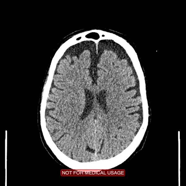 File:Artery of Percheron infarction (Radiopaedia 28679-28967 Axial non-contrast 77).jpg