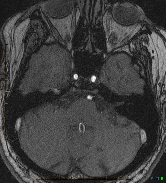 File:Artifactual basilar artery stenosis due to metallic stent (Radiopaedia 31206-31922 Axial MRA 3).jpg