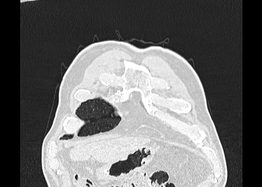 Asbestos pleural placques (Radiopaedia 57905-64872 Coronal lung window 11).jpg