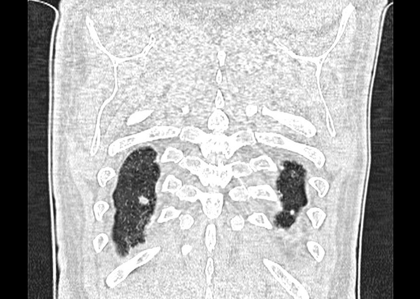 Asbestos pleural placques (Radiopaedia 57905-64872 Coronal lung window 274).jpg