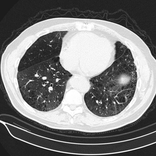 File:Aspergilloma (Radiopaedia 24521-24804 Axial lung window 18).jpg