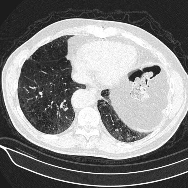 File:Aspergilloma (Radiopaedia 24521-24804 Axial lung window 21).jpg