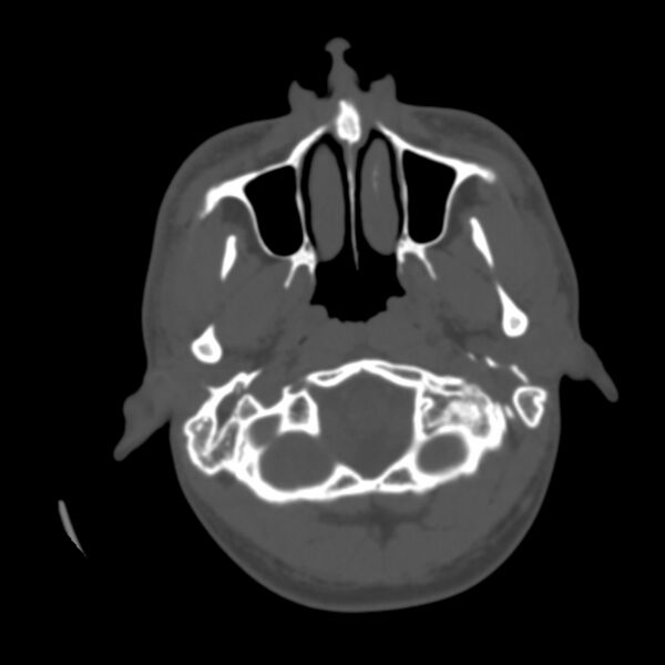 File:Asymptomatic occipital spur (Radiopaedia 87753-104201 Axial bone window 6).jpg