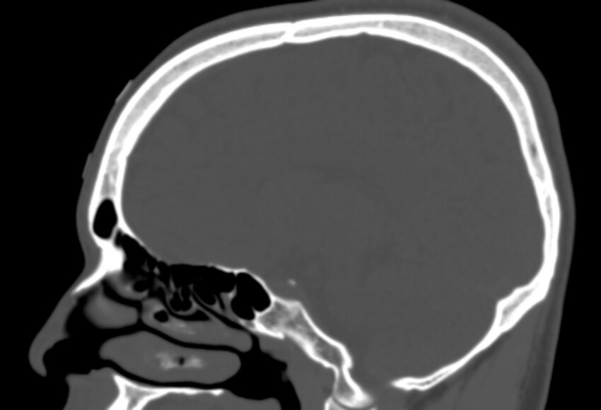 Asymptomatic occipital spur (Radiopaedia 87753-104201 Sagittal bone window 133).jpg