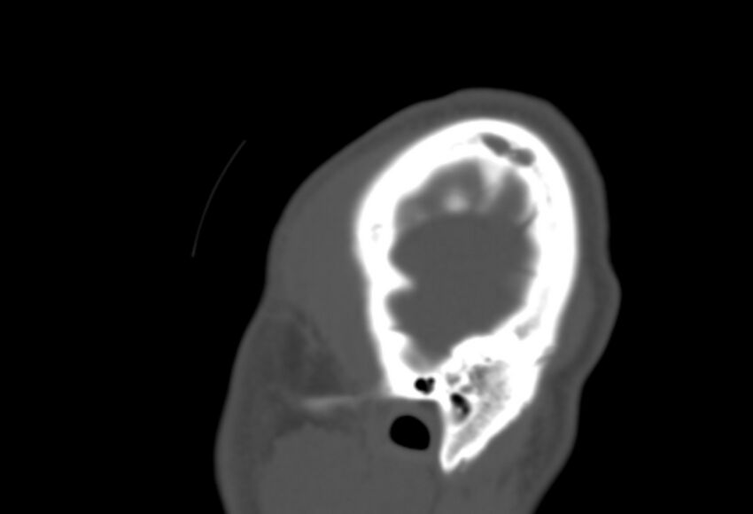 Asymptomatic occipital spur (Radiopaedia 87753-104201 Sagittal bone window 300).jpg