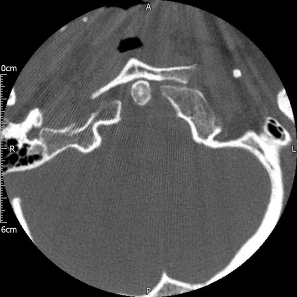 File:Atlas fracture with Currarino type A congenital defect (Radiopaedia 71747-82144 Axial bone window 16).jpg