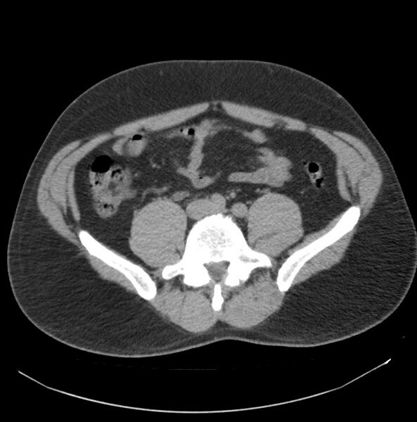 File:Atrophic kidney due to severe chronic obstructive hydronephrosis (Radiopaedia 40828-43474 Axial non-contrast 24).jpg