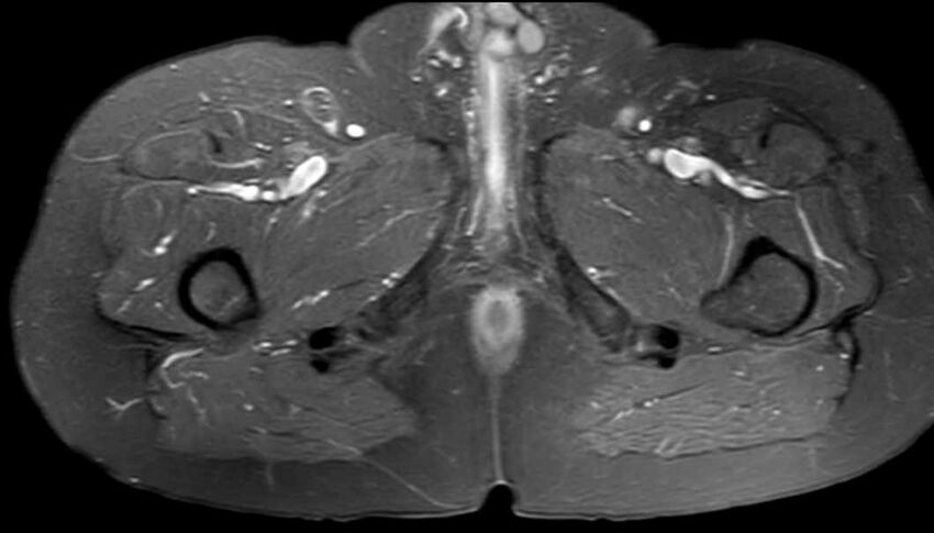Atypical lipomatous tumor - thigh (Radiopaedia 68975-78734 Axial PD fat sat 80).jpg