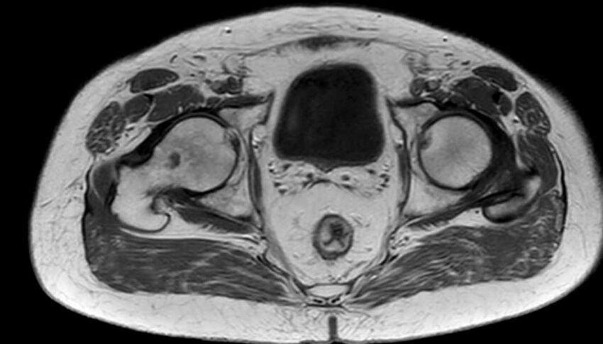Atypical lipomatous tumor - thigh (Radiopaedia 68975-78734 Axial T1 93).jpg