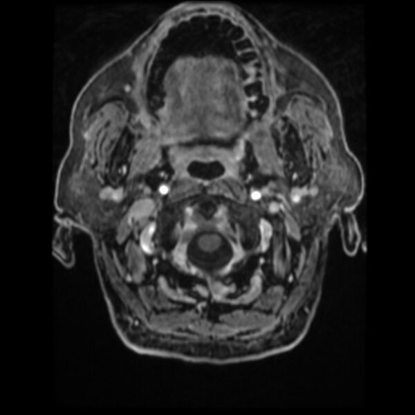 File:Atypical meningioma (Radiopaedia 45535-49629 Axial T1 C+ 13).jpg