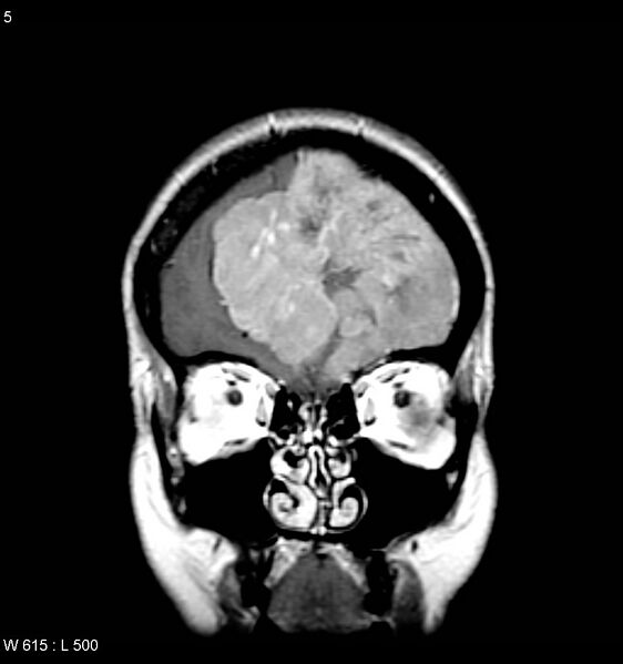 File:Atypical meningioma (WHO grade II) (Radiopaedia 7762-8586 Coronal T1 C+ 3).jpg
