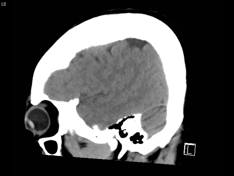 File:Atypical meningioma - intraosseous (Radiopaedia 64915-73867 C 16).jpg