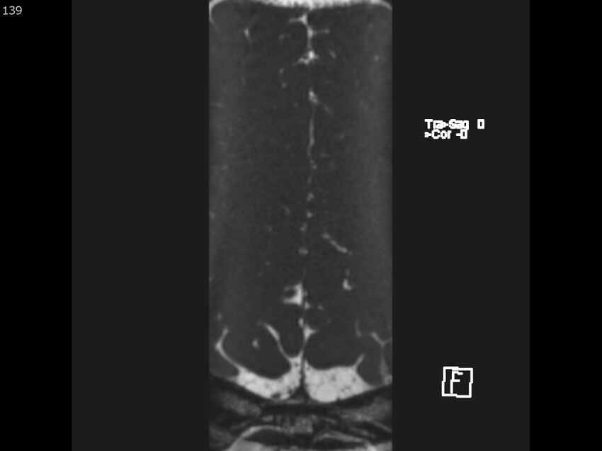 Atypical meningioma - intraosseous (Radiopaedia 64915-74572 Axial CISS 139).jpg