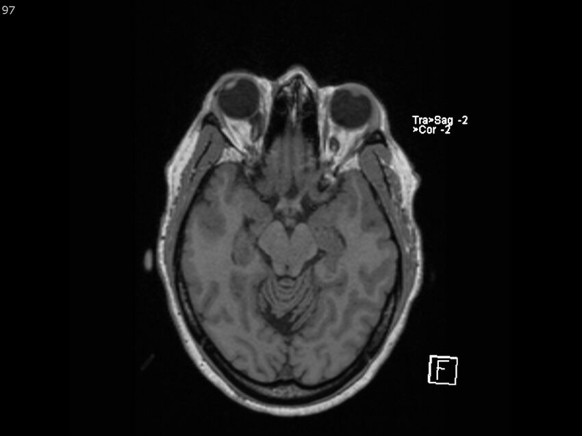 Atypical meningioma - intraosseous (Radiopaedia 64915-74572 Axial T1 97).jpg
