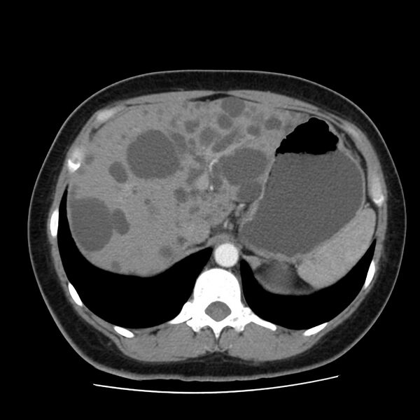 File:Autosomal dominant polycystic kidney disease (Radiopaedia 23061-23093 B 16).jpg