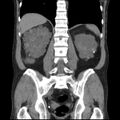 Autosomal dominant polycystic kidney disease (Radiopaedia 36539-38101 C 49).jpg