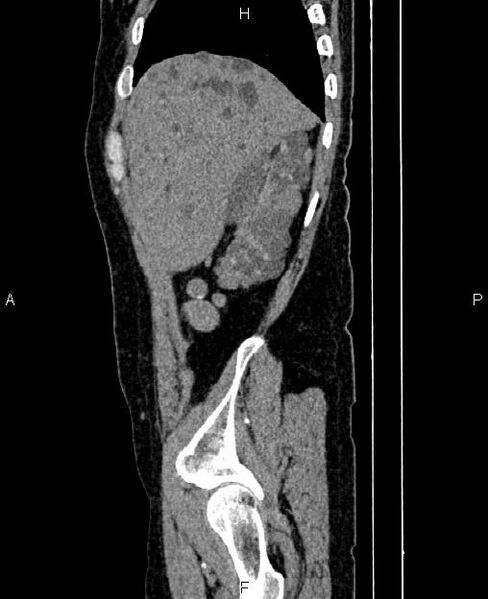 File:Autosomal dominant polycystic kidney disease (Radiopaedia 87830-104287 C 11).jpg