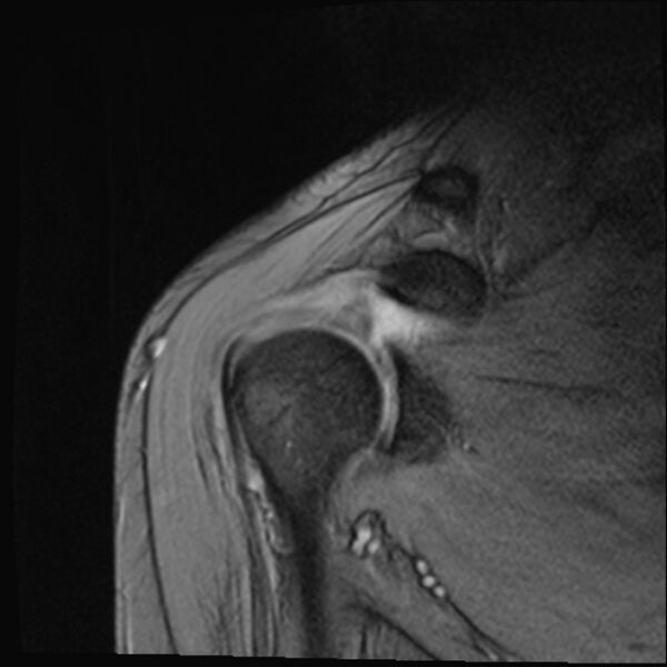 File:Avulsion fracture - greater tuberosity of humerus (Radiopaedia 71216-81515 Coronal T2 13).jpg