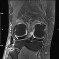 Avulsion fracture of the fibular head (Radiopaedia 74804-85808 Coronal PD fat sat 26).jpg