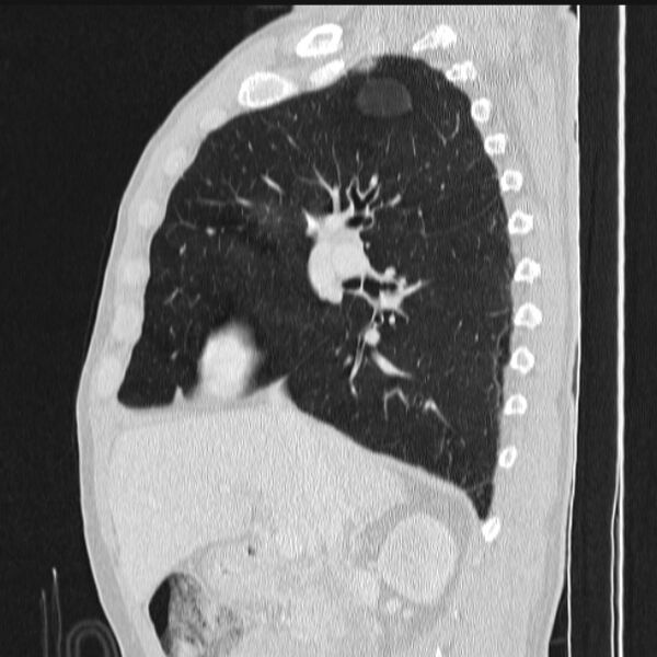 File:Azygos lobe (Radiopaedia 38259-40275 lung window 40).jpg