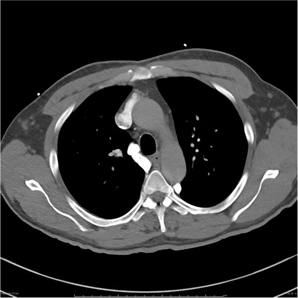 File:Azygos venous system anatomy (CT pulmonary angiography) (Radiopaedia 25928-26077 Axial C+ CTPA 26).jpg