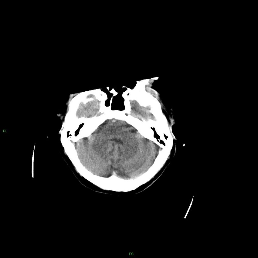 Basal ganglia hemorrhage (Radiopaedia 58349-65472 Axial non-contrast 44).jpg