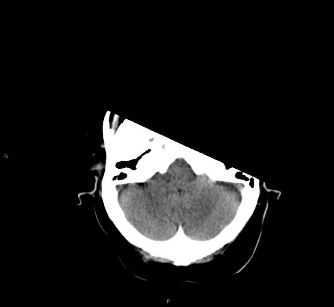 File:Basal ganglia hemorrhage (Radiopaedia 58759-65981 Axial non-contrast 41).jpg