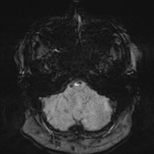 File:Basilar artery dissection (Radiopaedia 77032-88976 Axial SWI 9).jpg