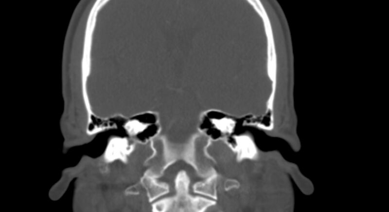 File:Benign mixed salivary tumor of the parotid gland (Radiopaedia 35261-36792 Coronal bone window 20).jpg