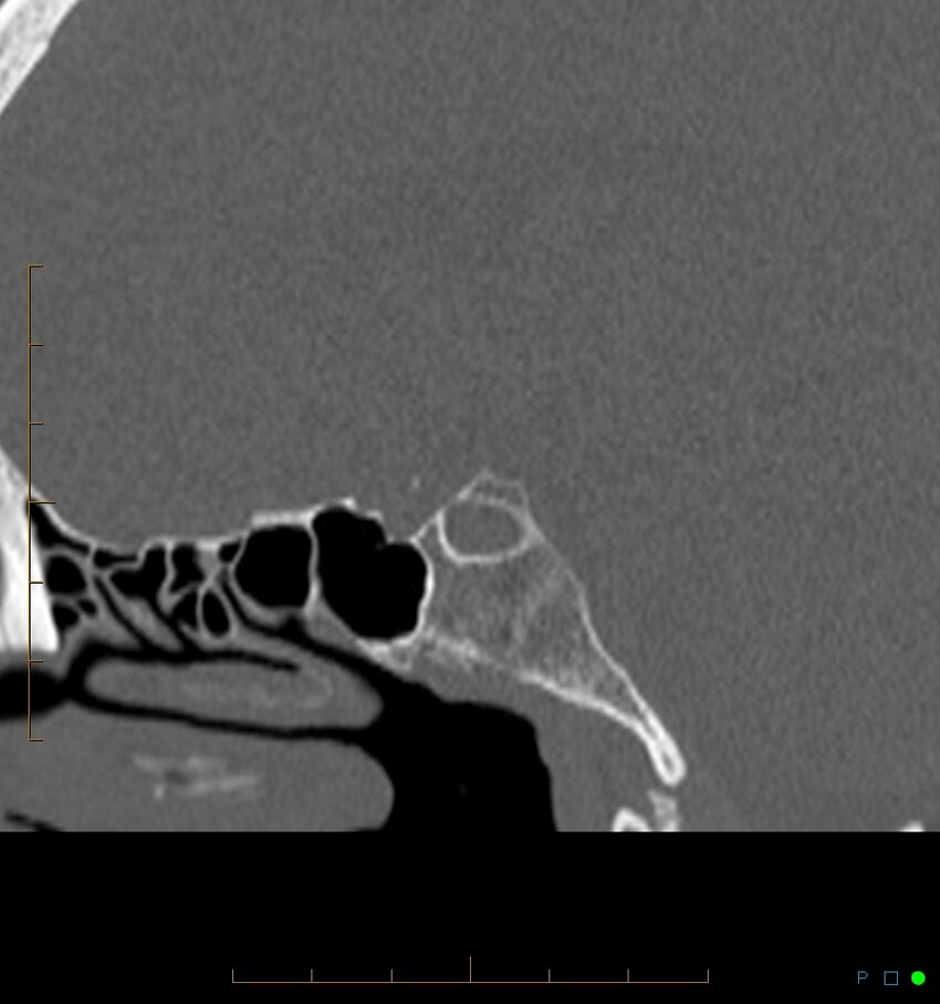 Benign notochordal cell tumor (probable) (Radiopaedia 65475-74546 Sagittal bone window 14).jpg