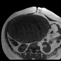 Benign seromucinous cystadenoma of the ovary (Radiopaedia 71065-81300 Axial T1 27).jpg