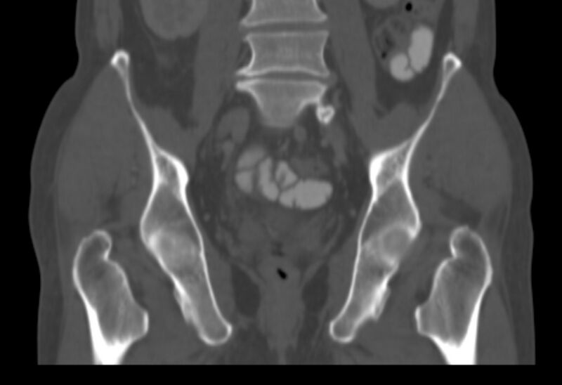 File:Bertolotti syndrome (Radiopaedia 58974-66235 Coronal bone window 19).jpg