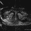 Bicornuate uterus- on MRI (Radiopaedia 49206-54297 Axial ADC 26).jpg
