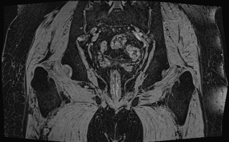 File:Bilateral avascular necrosis of femoral head (Radiopaedia 77116-89078 Coronal T2 we 11).jpg