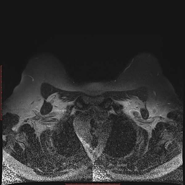 File:Bilateral breast implant rupture (Radiopaedia 24761-25027 T2 fat sat 4).jpg
