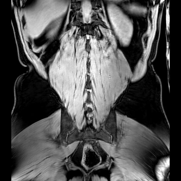 File:Bilateral conjoined nerve roots at different levels (Radiopaedia 73312-84063 Coronal WE 47).jpg