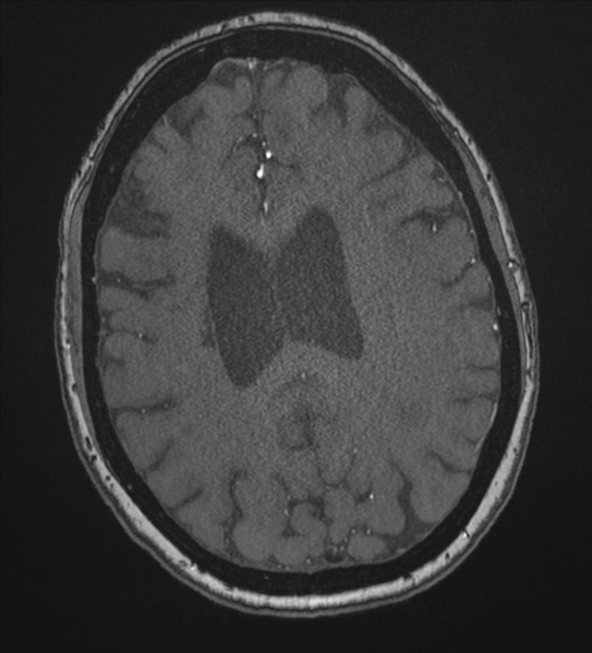 File:Bilateral fetal posterior communicating arteries (Radiopaedia 41286-44102 Axial MRA 153).png