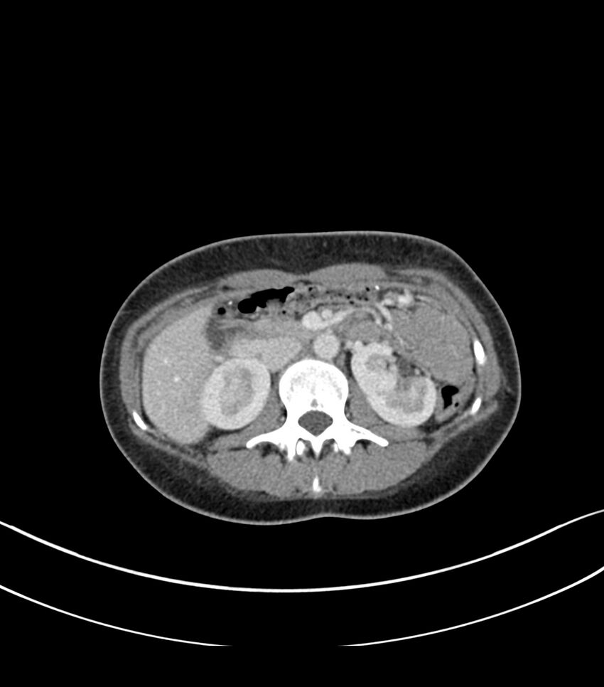 Bilateral kidney malrotation (Radiopaedia 72227-82749 A 20).jpg