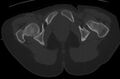 Bilateral mature cystic ovarian teratoma (Radiopaedia 88821-105592 Axial bone window 60).jpg