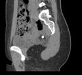 Bilateral mature cystic ovarian teratoma (Radiopaedia 88821-105592 D 17).jpg