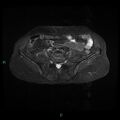 Bilateral ovarian fibroma (Radiopaedia 44568-48293 Axial STIR 1).jpg