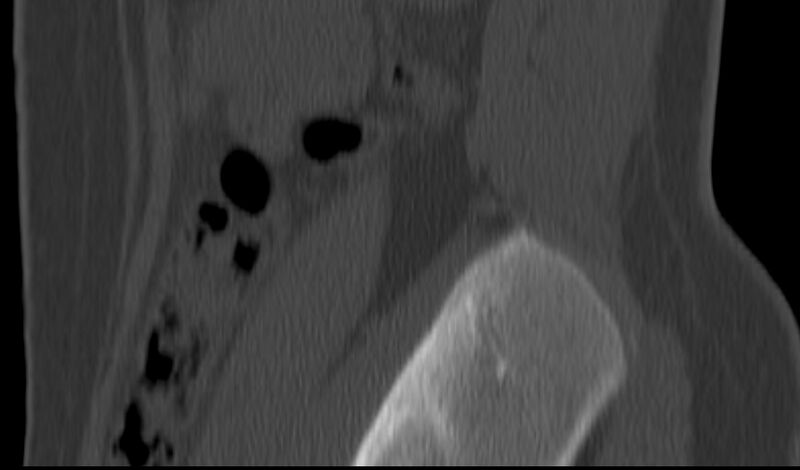 File:Bilateral pars defect (Radiopaedia 26691-26846 Sagittal bone window 2).jpg