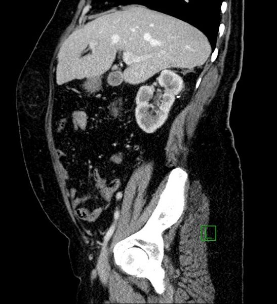 File:Bilateral sporadic synchronous clear cell renal cell carcinoma (Radiopaedia 85035-100575 G 77).jpg
