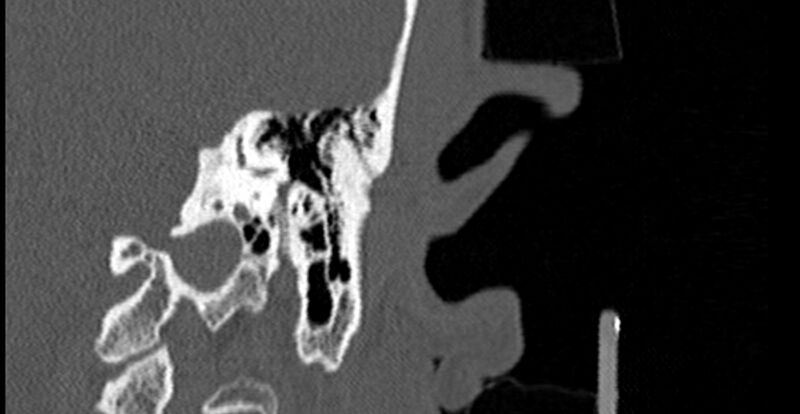 File:Bilateral temporal bone fractures (Radiopaedia 29482-29970 B 55).jpg