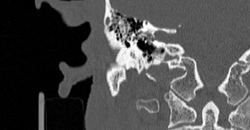 File:Bilateral temporal bone fractures (Radiopaedia 29482-29970 Coronal non-contrast 115).jpg