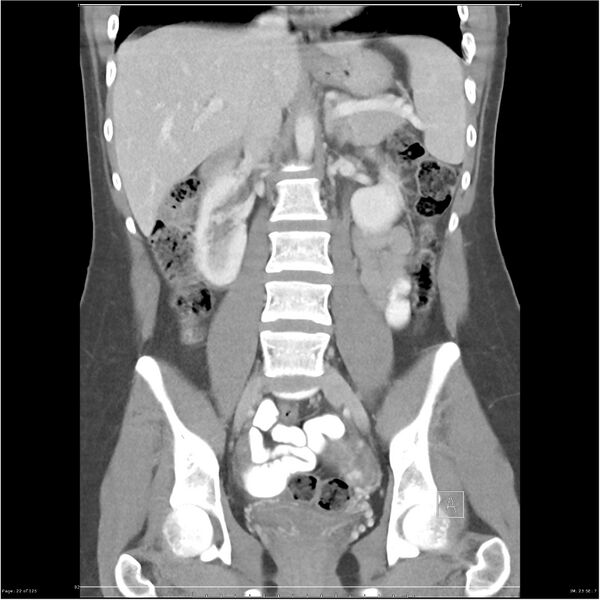 File:Bilateral ureteritis and cystitis (Radiopaedia 25340-25594 B 22).jpg