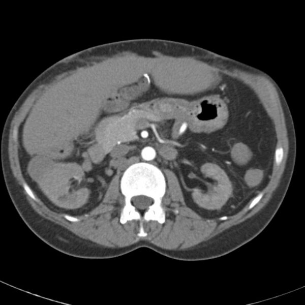 File:Biliary necrosis - liver transplant (Radiopaedia 21876-21845 A 25).jpg