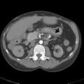 Biliary necrosis - liver transplant (Radiopaedia 21876-21845 A 26).jpg