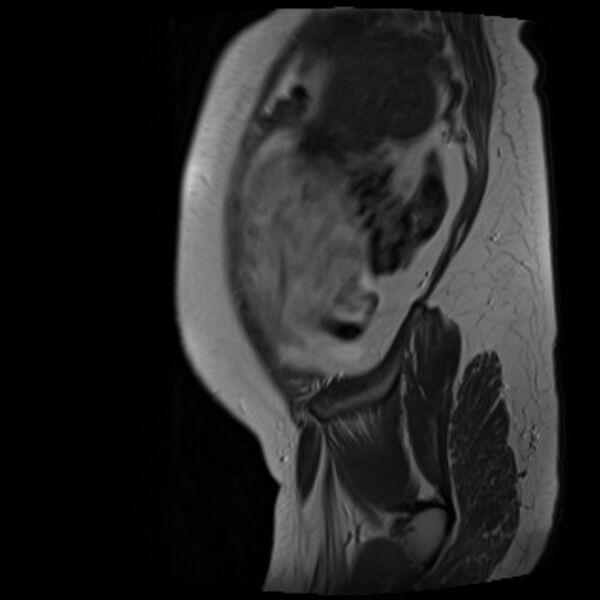 File:Bilobed placenta accreta (Radiopaedia 69648-79591 Sagittal T2 38).jpg
